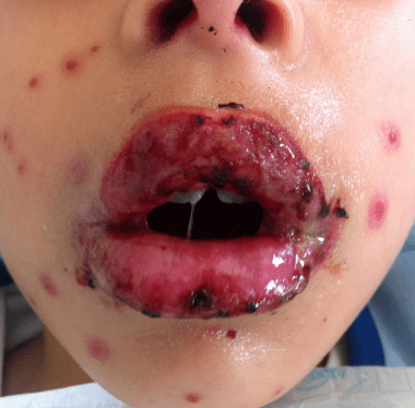 万孚生物：呼吸道合胞病毒、腺病毒、肺炎支原体联合检测试剂取得产品注册证